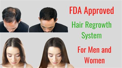 Hair Regrowth System For Men And Women Reviews Youtube