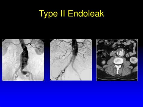 Ppt Endoleaks Graft Extension Or Coil Embolization Powerpoint