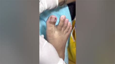 Ep3833 Ingrown Toenail Removal 👣 เจ็บนิดนึงเก่งมาก 😷 Clip From