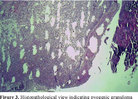 Figure 1 From Posthaste Outgrow Of Lip Pyogenic Granuloma After Diode