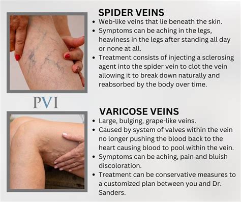 Spider Veins Vs Varicose Veins