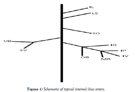 Variations observed of the internal iliac artery and their possible ...