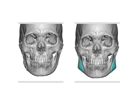 Plastic Surgery Case Study Custom Jaw Angle Implants For