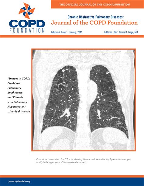 COPD Images: Emphysema & Fibrosis with Hypertension | Journal of COPD ...