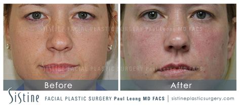 Restylane Juvederm Before And After 55 Sistine Facial Plastic Surgery