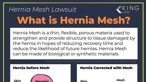 Bard Hernia Mesh Lawsuits Plaintiffs Demand Remand Amid Stalled