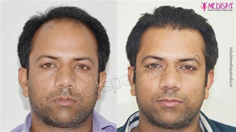 Hair Transplant Before After 1 Year Results Medispa India