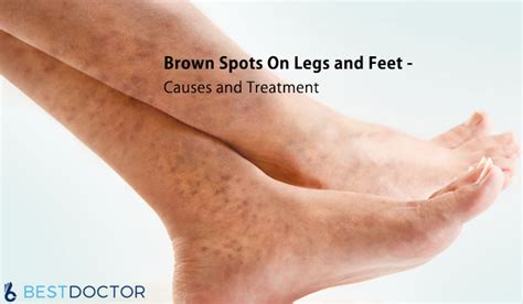 Brown Spots On Legs and Feet - Causes and Treatment