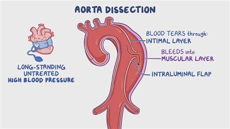 Video Aortic Dissection Clinical Sciences