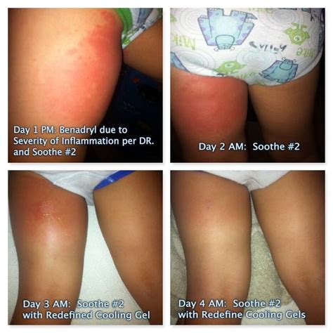 Soothe Inflammation Irritation Redness Sunburn For