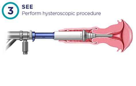 Omni Lok Cervical Seal Omni K Video System Omni Hysteroscope Hologic