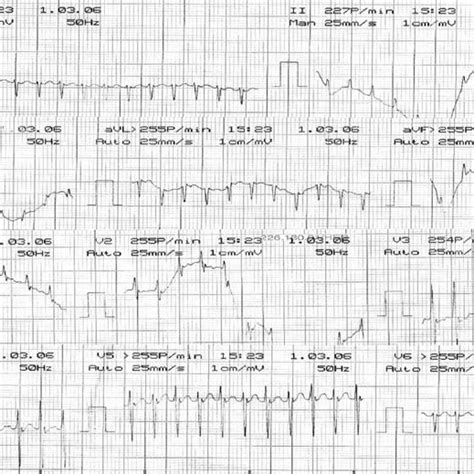 ECG De La Paciente Del Caso 4 Episodio De Taquicardia Con QRS Estrecho