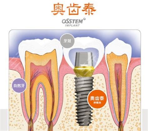 美国种植牙品牌排行榜名称盘点 爱丽帮