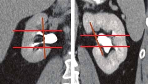 Contrast-enhanced coronal CT scans of the kidney, in the delayed phase ...