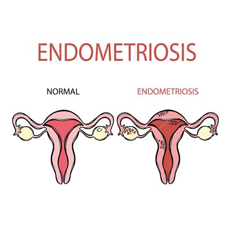 Premium Vector | ENDOMETRIOSIS NORMAL FEMALE Reproductive System Education