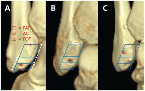 Nonanatomic All Inside Arthroscopic Anterior Talofibular 45 Off