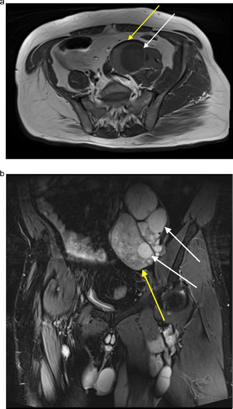 Primary Intramuscular And Intermuscular Echinococcal Disease Of The