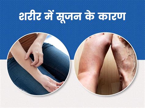 शरीर में सूजन क्यों आती है डॉक्टर से जानें इसके 6 कारण और बचाव के उपाय Body Inflammation