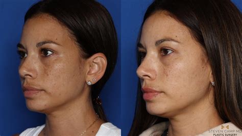 Sciton Laser Before And After Pictures Case 535 Fort Worth Texas