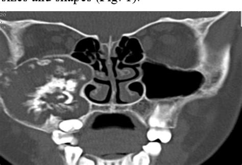 Figure 1 From A Large Ameloblastic Fibro Odontoma Of The Maxillary