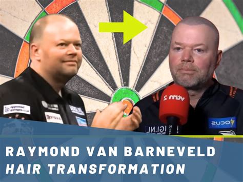 Raymond Van Barneveld Hair Transplant Hair Loss Analysis