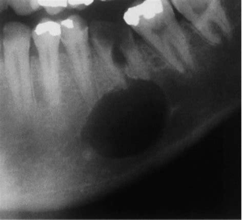 Cysts In And Around The Jaws Flashcards Quizlet