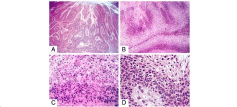 Warty Basaloid Squamous Cell Carcinoma A Exophytic Warty Carcinoma