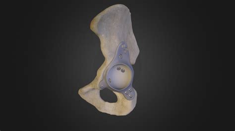 Implant 3d Model By Baltic Implants Balticrad [2b1c594] Sketchfab