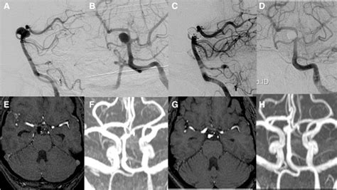 Cerebral Angiogram Lateral A And Anteroposterior B Catheter