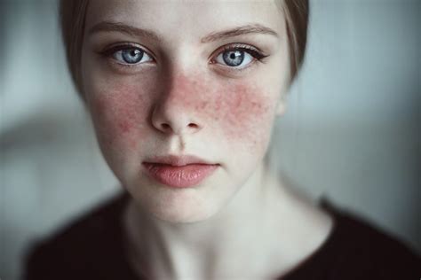 Bệnh lupus ban đỏ có lây không? Xem câu trả lời ngay TẠI ĐÂY!