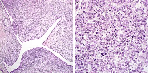 Smarca4 Deficient Undifferentiated Uterine Sarcoma Malignant Rhabdoid Tumor Of The Uterus A