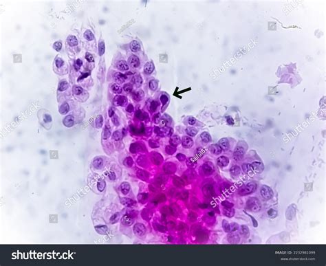 Microscopic View Trichomonas Vaginalis Pap Smear Stock Photo 2232981099 ...