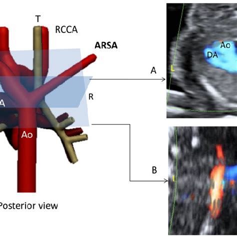 Case Of Aberrant Right Subclavian Artery Arsa A Three Download Scientific Diagram