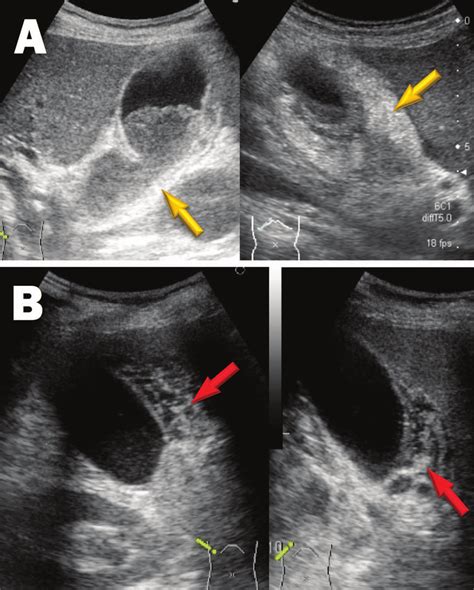 Chronic Cholecystitis Ultrasound