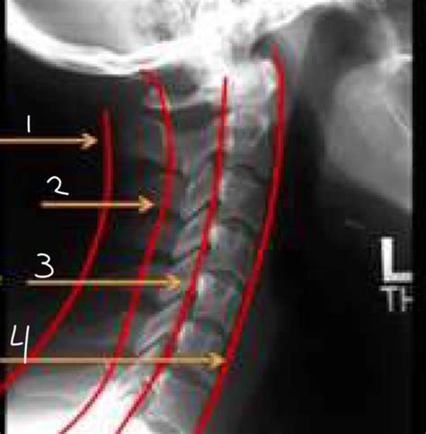 Lecture 7 Cervical Spine Trauma Flashcards Quizlet