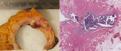 Cystectomy Specimen And Gross Appearance Of Urc The Neoplasm Is