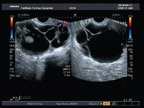 Both Images Show Multilocular Cyst With Solid Component 3 Papillary