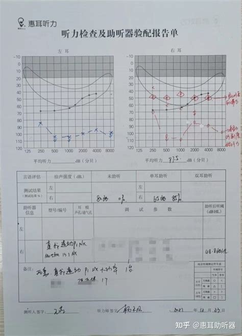 重庆（惠耳听力）助听器：西嘉（西门子）大功率助听器选配案例！ 知乎