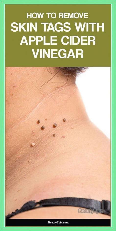 How To Remove Skin Tags Safely With Iodine Artofit