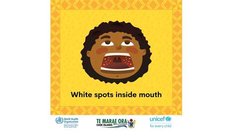 Symptoms Of Measles Poster Te Marae Ora Cook Islands Ministry Of Health