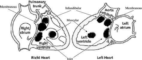 Types Of Vsd Defects Hot Sex Picture