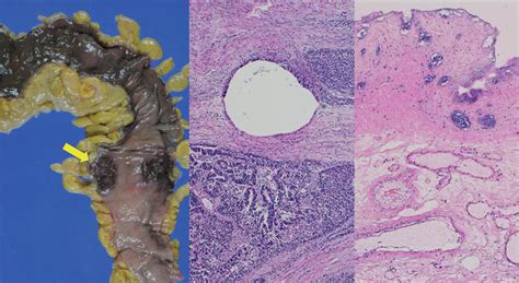 Renal Papillary Necrosis Histology