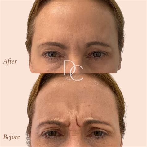 The Definitive Guide To Anti Wrinkle Treatments How And How Long They