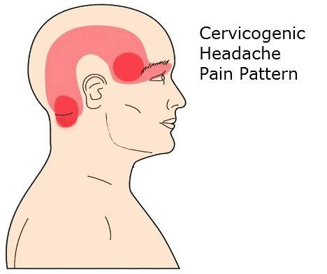 Can Neck Pain Cause Headache | Exercises That Help Relieve Pain At DPT