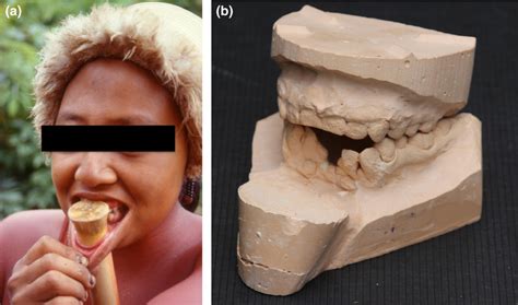 Zoé Woman Brazil With Wooden Lip Plug And B Jaw Model With Late Download Scientific