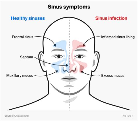 How To Relieve Sinus Pressure Naturally - Memberfeeling16