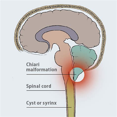 Syringomyelia - Greg Kornegay, Attorney at Law Wilmington NC