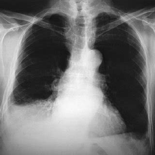 Chest Computed Tomography Right Infrahilar Mass And Atelectasis Of The