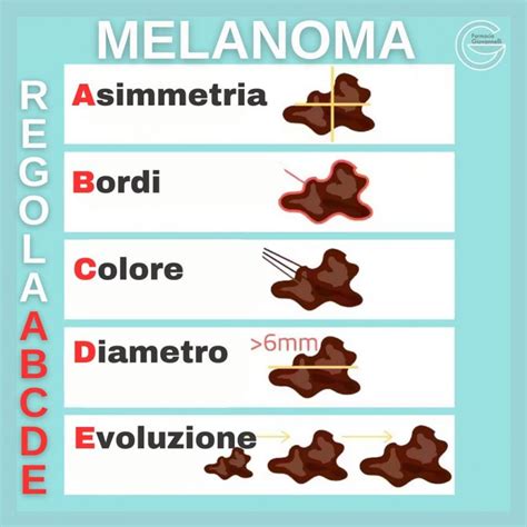 Vasto Come Riconoscere Un Neo Sospetto Melanoma Uno Dei Tumori Pi