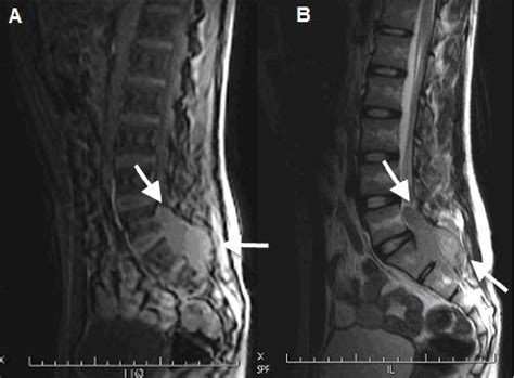 Figure 2 From Sacral Ewing S Sarcoma And Challenges In It S Diagnosis